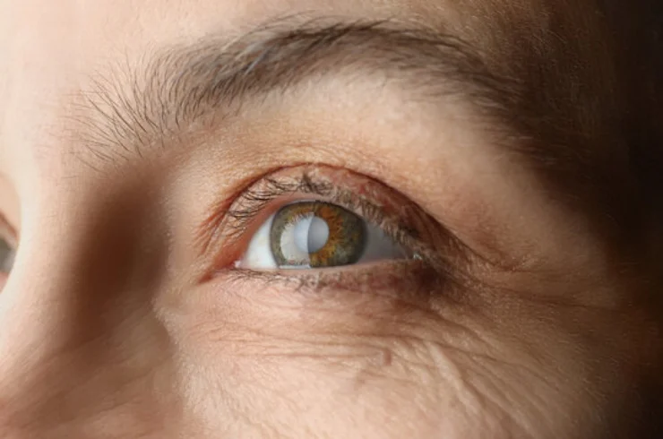 Cataract------16
