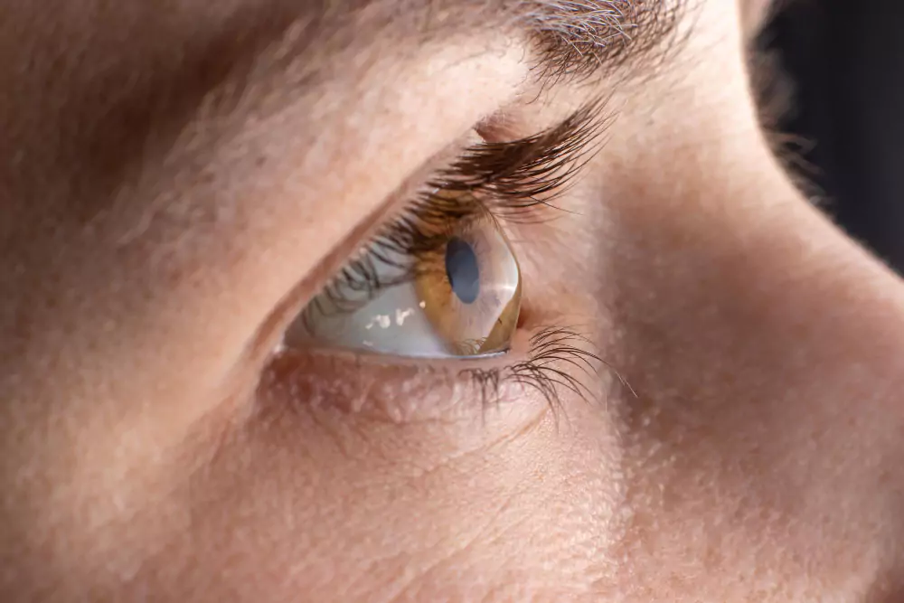keratoconus