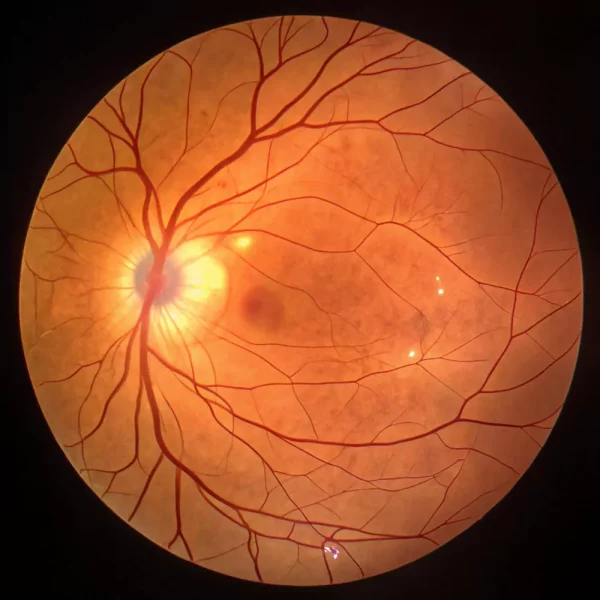 retina